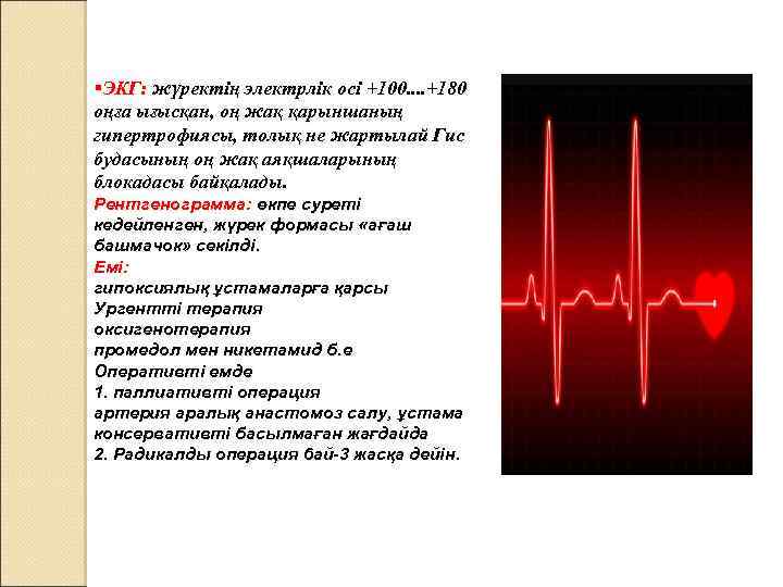 §ЭКГ: жүректің электрлік осі +100. . +180 оңға ығысқан, оң жақ қарыншаның гипертрофиясы, толық