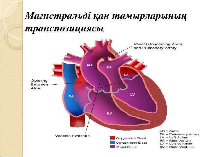 Магистральді қан тамырларының транспозициясы 