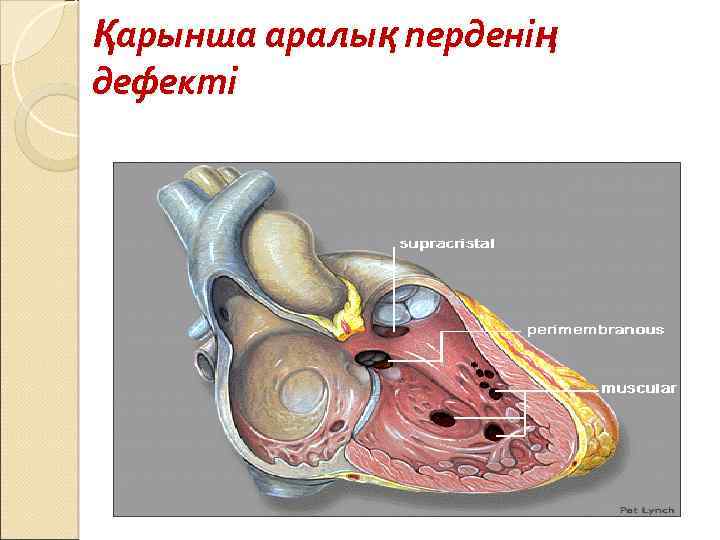 Қарынша аралық перденің дефекті 