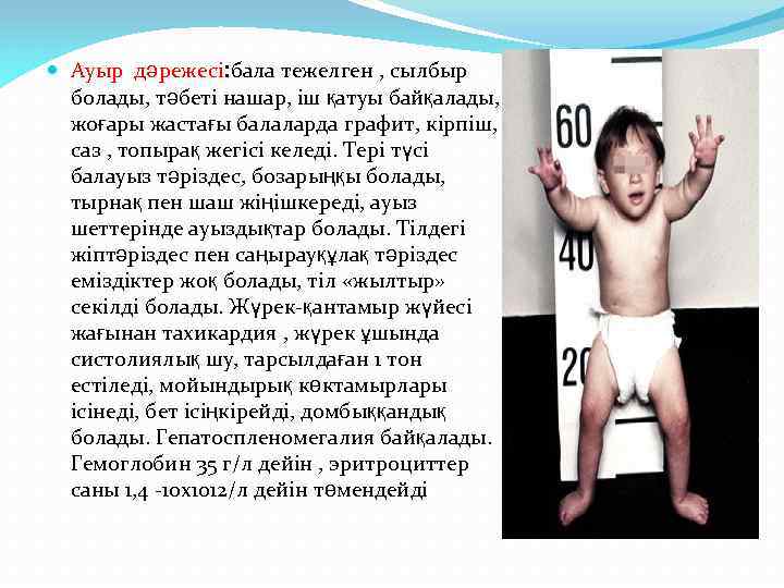  Ауыр дәрежесі: бала тежелген , сылбыр болады, тәбеті нашар, іш қатуы байқалады, жоғары