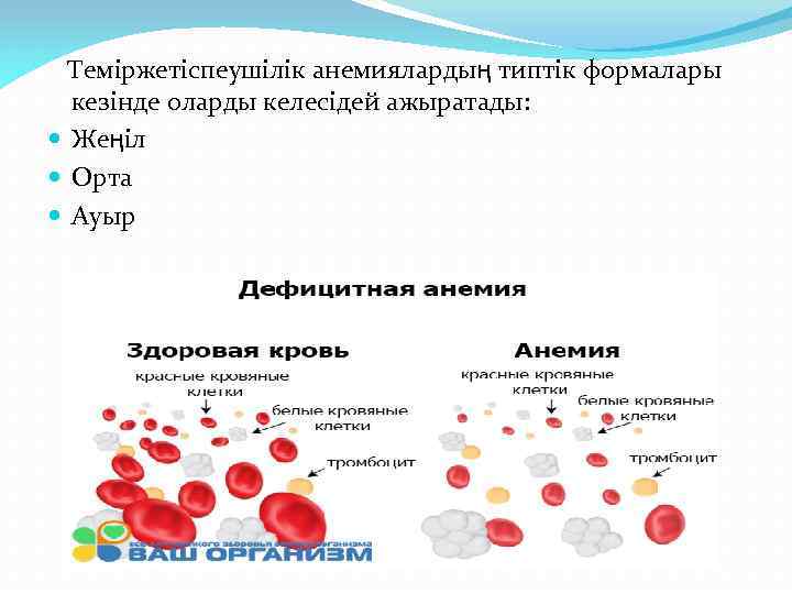  Теміржетіспеушілік анемиялардың типтік формалары кезінде оларды келесідей ажыратады: Жеңіл Орта Ауыр 