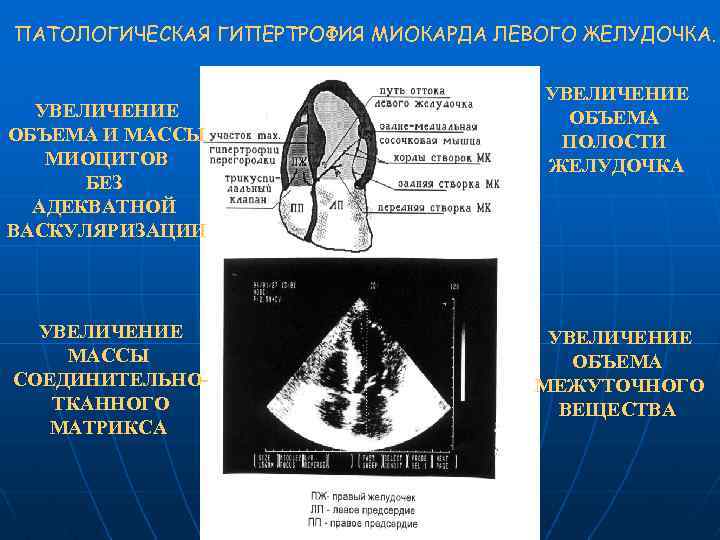 Увеличение левого желудочка