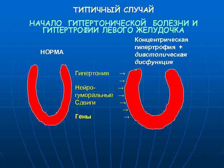 ТИПИЧНЫЙ СЛУЧАЙ НАЧАЛО ГИПЕРТОНИЧЕСКОЙ БОЛЕЗНИ И ГИПЕРТРОФИИ ЛЕВОГО ЖЕЛУДОЧКА Концентрическая гипертрофия + диастолическая дисфункция