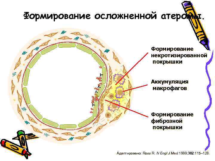 Формирование осложненной атеромы. Формирование некротизированной покрышки Аккумуляция макрофагов Формирование фиброзной покрышки Адаптировано: Ross R.