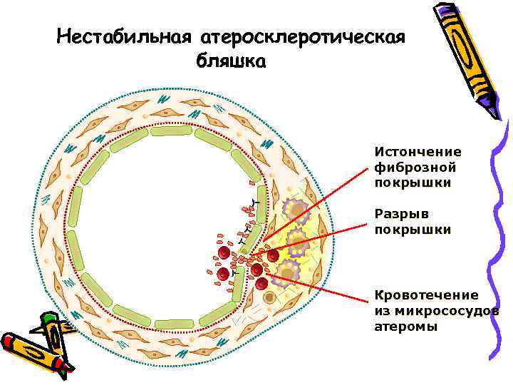 Стабильная атеросклеротическая бляшка