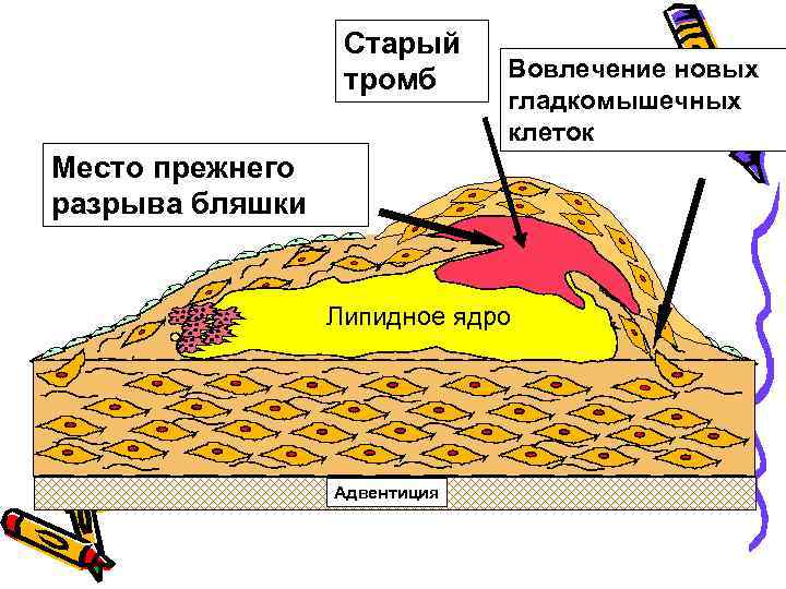 Рост бляшки Старый тромб Вовлечение новых гладкомышечных клеток Место прежнего разрыва бляшки lipid core