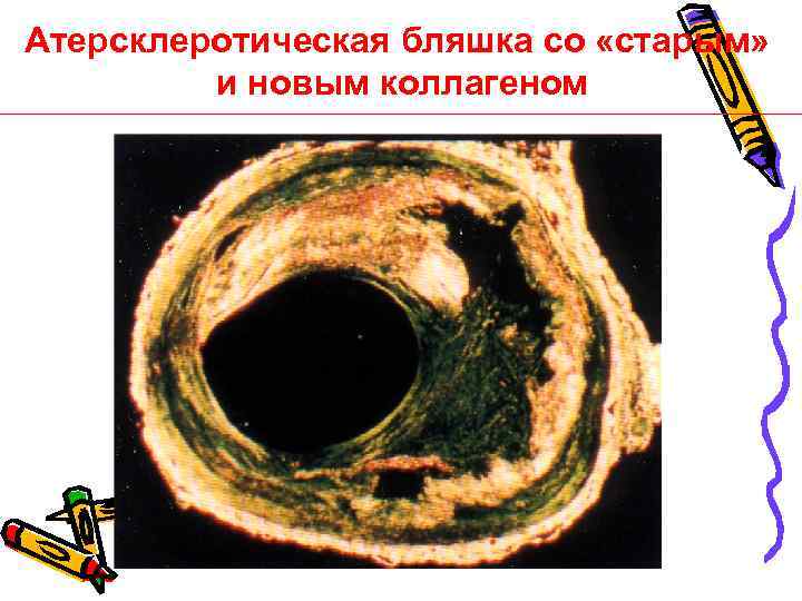 Атерсклеротическая бляшка со «старым» и новым коллагеном Davies, 1999 