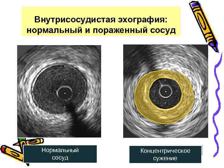 Внутрисосудистая эхография: нормальный и пораженный сосуд Aventitia EEM Border Media Intima Lumen Catheter Guide