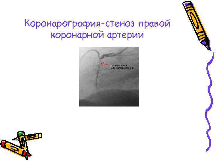 Коронарография-стеноз правой коронарной артерии 