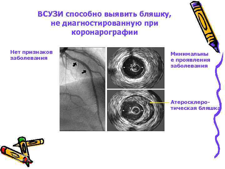 ВСУЗИ способно выявить бляшку, не диагностированную при коронарографии Коронарограмма Нет признаков заболевания ВСУЗИ Минимальны