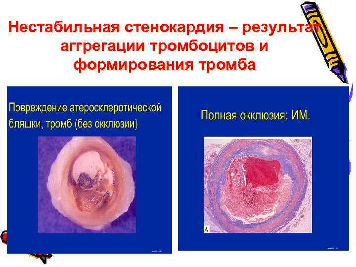 Нестабильная стенокардия – результат аггрегации тромбоцитов и формирования тромба 