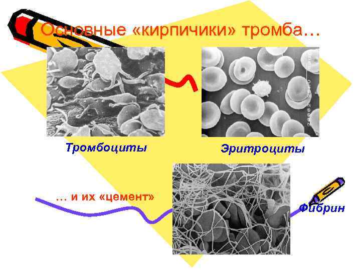 Основные «кирпичики» тромба… Тромбоциты … и их «цемент» Эритроциты Фибрин 