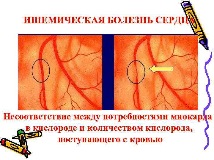 ИШЕМИЧЕСКАЯ БОЛЕЗНЬ СЕРДЦА Несоответствие между потребностями миокарда в кислороде и количеством кислорода, поступающего с