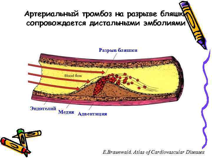 Артериальный тромбоз на разрыве бляшки сопровождается дистальными эмболиями Разрыв бляшки Эндотелий Медия Адвентиция E.