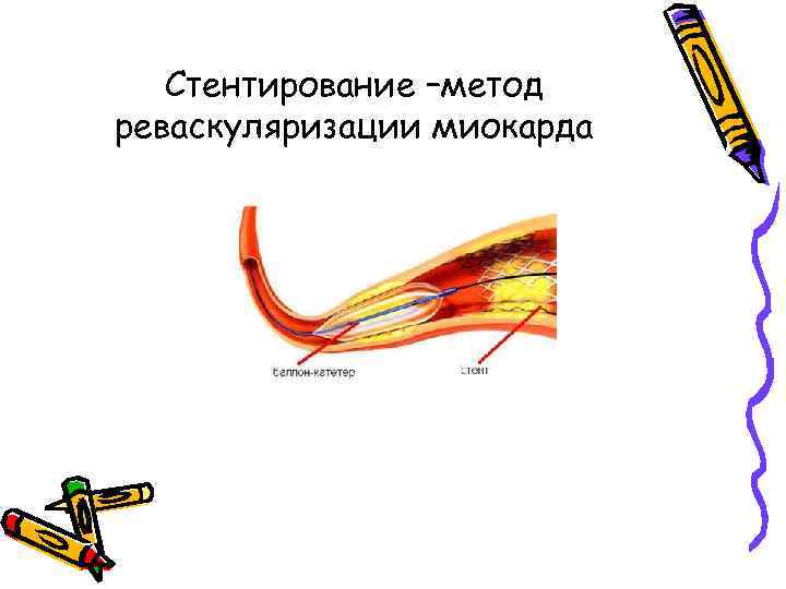 Стентирование –метод реваскуляризации миокарда 