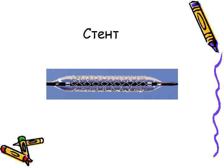 Стент 