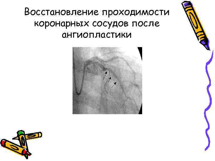 Восстановление проходимости коронарных сосудов после ангиопластики 