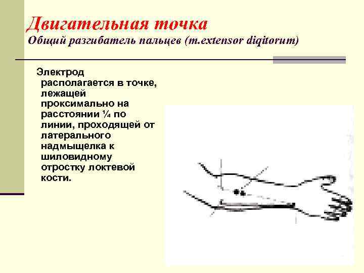 Двигательная точка Общий разгибатель пальцев (m. extensor diqitorum) Электрод располагается в точке, лежащей проксимально