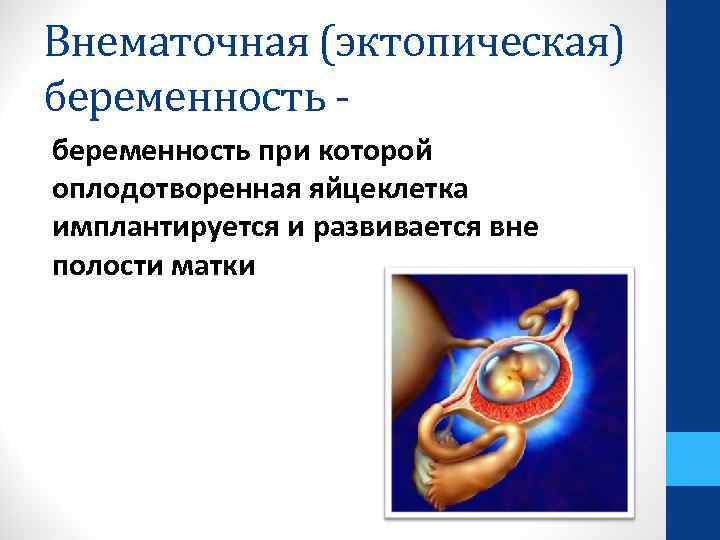 Внематочная (эктопическая) беременность при которой оплодотворенная яйцеклетка имплантируется и развивается вне полости матки 