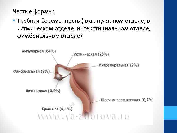 Частые формы: • Трубная беременность ( в ампулярном отделе, в истмическом отделе, интерстициальном отделе,