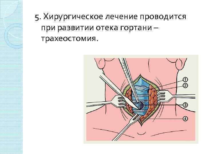 5. Хирургическое лечение проводится при развитии отека гортани – трахеостомия. 