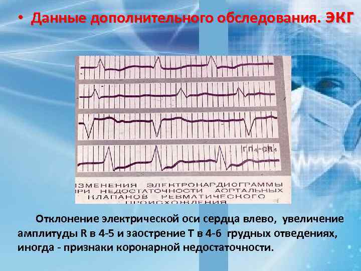  • Данные дополнительного обследования. экг Отклонение электрической оси сердца влево, увеличение амплитуды R