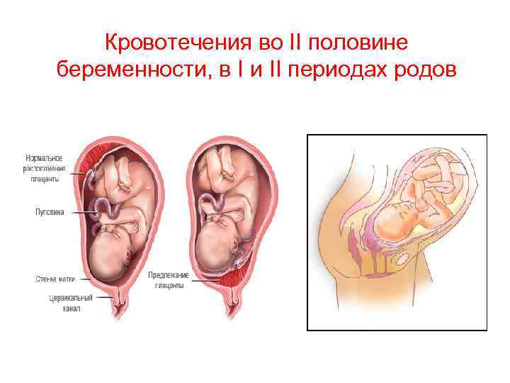 Кровотечения во II половине беременности, в I и II периодах родов 