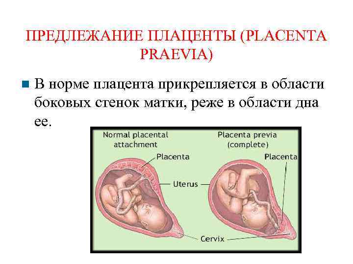 ПРЕДЛЕЖАНИЕ ПЛАЦЕНТЫ (PLACENTA PRAEVIA) В норме плацента прикрепляется в области боковых стенок матки, реже