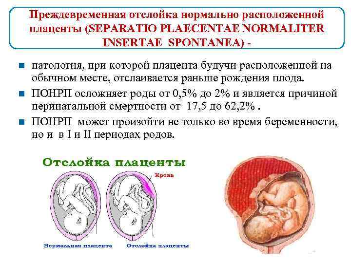 Преждевременная отслойка нормально расположенной плаценты (SEPARATIO PLAECENTAE NORMALITER INSERTAE SPONTANEA) патология, при которой плацента