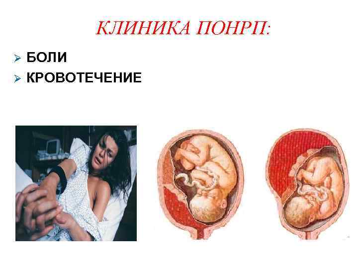 КЛИНИКА ПОНРП: БОЛИ КРОВОТЕЧЕНИЕ 