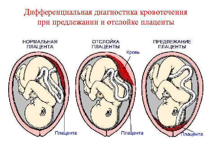Дифференциальная диагностика кровотечения при предлежании и отслойке плаценты 