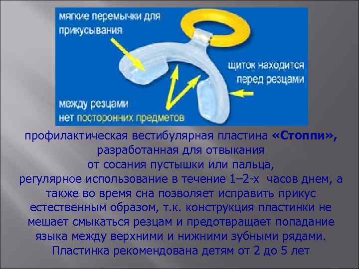 профилактическая вестибулярная пластина «Стоппи» , разработанная для отвыкания от сосания пустышки или пальца, регулярное