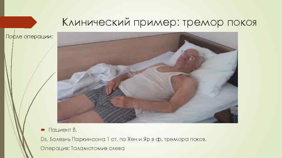 Клинический пример: тремор покоя После операции: Пациент В. Ds. Болезнь Паркинсона 1 ст. по
