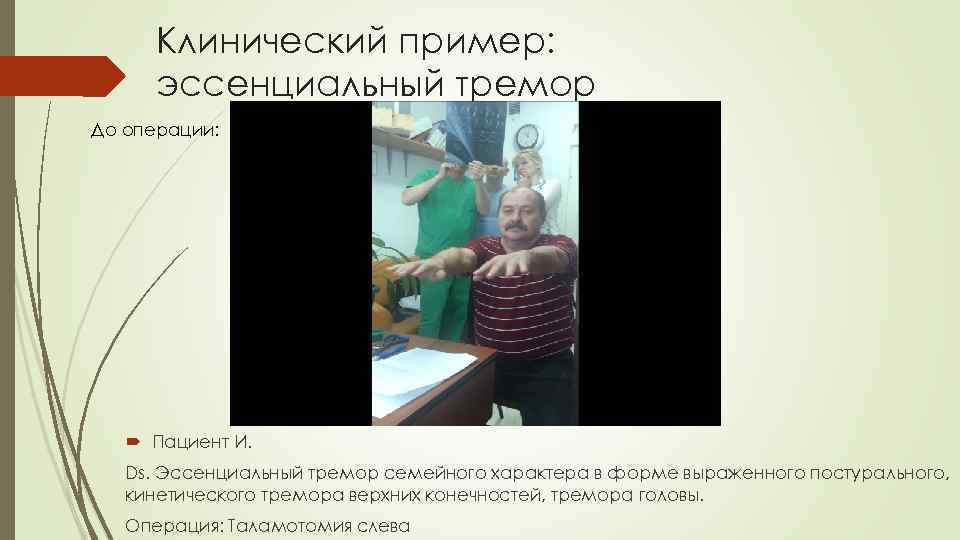 Клинический пример: эссенциальный тремор До операции: Пациент И. Ds. Эссенциальный тремор семейного характера в