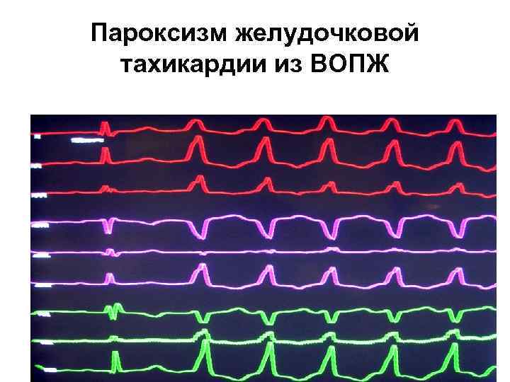 Наджелудочковая тахикардия карта вызова скорой медицинской помощи