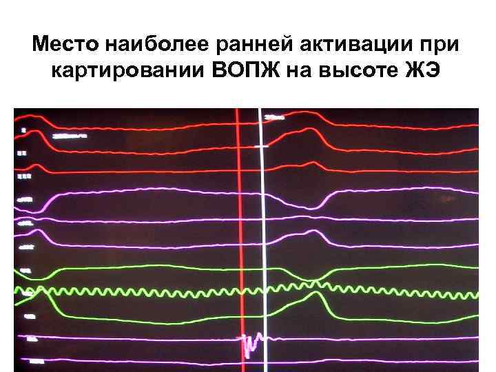 Место наиболее ранней активации при картировании ВОПЖ на высоте ЖЭ 
