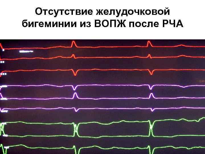 Отсутствие желудочковой бигеминии из ВОПЖ после РЧА 