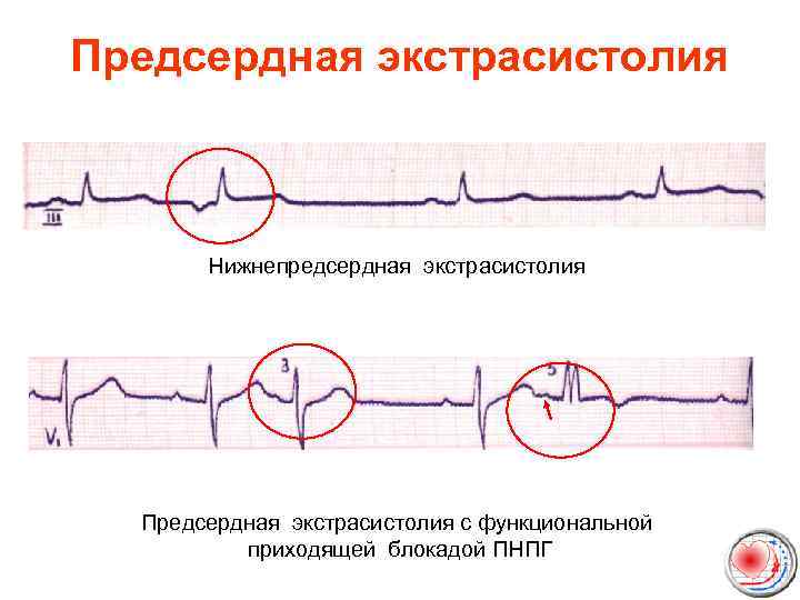Предсердная экстрасистолия Нижнепредсердная экстрасистолия Предсердная экстрасистолия с функциональной приходящей блокадой ПНПГ 
