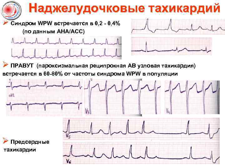 Синдром wpw карта вызова