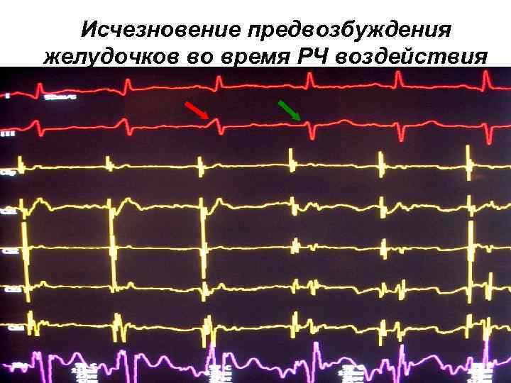 Исчезновение предвозбуждения желудочков во время РЧ воздействия 