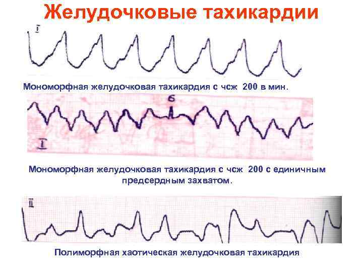 Желудочковые тахикардии Мономорфная желудочковая тахикардия с чсж 200 в мин. Мономорфная желудочковая тахикардия с