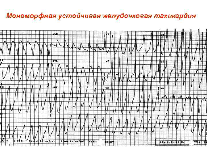 Мономорфная устойчивая желудочковая тахикардия 