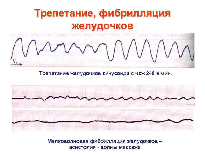 Трепетание, фибрилляция желудочков Трепетание желудочков синусоида с чсж 240 в мин. Мелковолновая фибрилляция желудочков