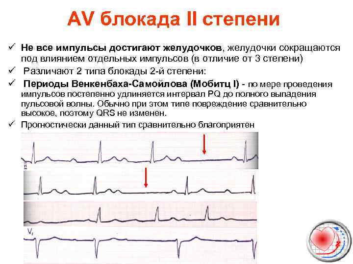 AV блокада II степени ü Не все импульсы достигают желудочков, желудочки сокращаются под влиянием