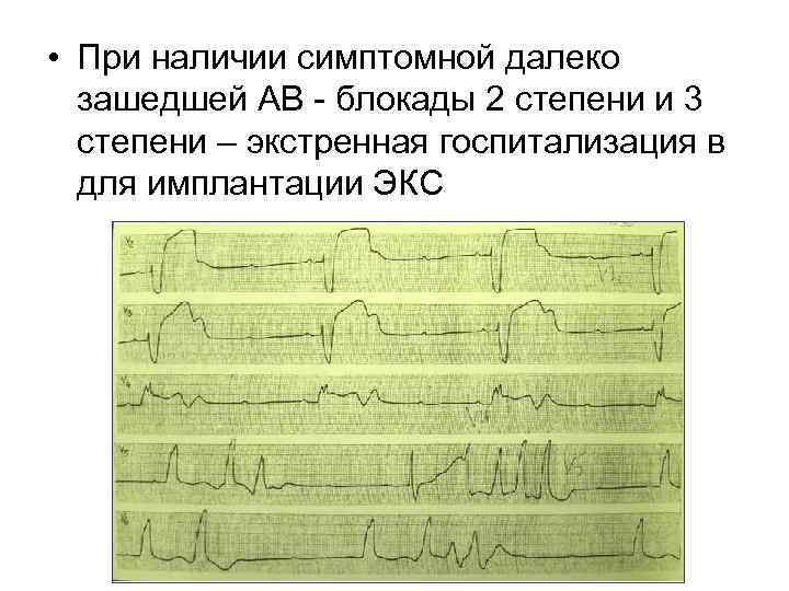  • При наличии симптомной далеко зашедшей АВ - блокады 2 степени и 3