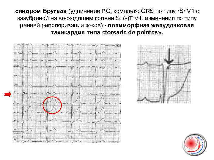 синдром Бругада (удлинение PQ, комплекс QRS по типу r. Sr V 1 c зазубриной