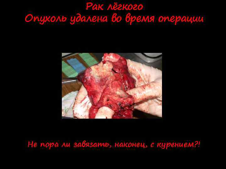 Рак лёгкого Опухоль удалена во время операции Не пора ли завязать, наконец, с курением?