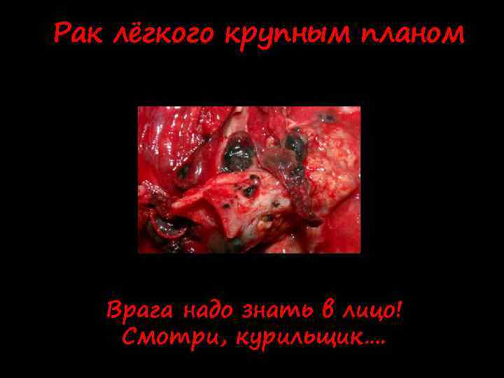 Рак лёгкого крупным планом Врага надо знать в лицо! Смотри, курильщик…. 