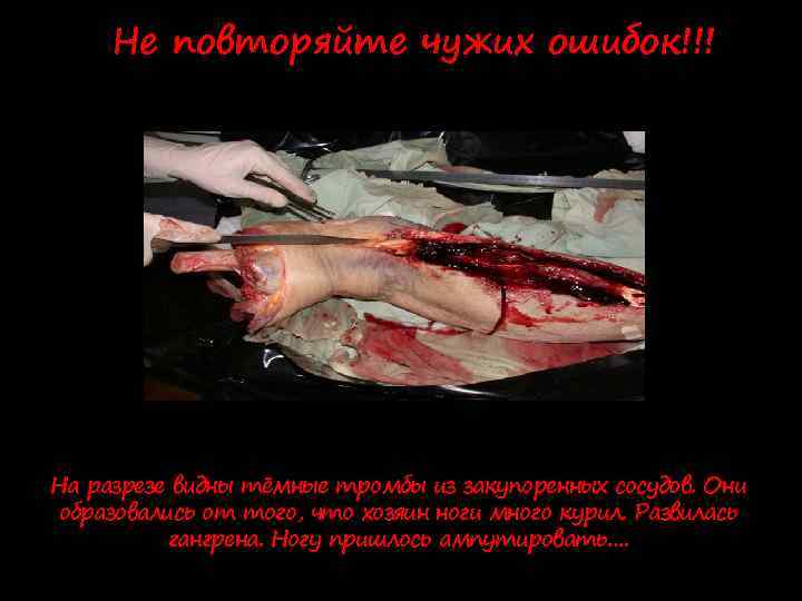 Не повторяйте чужих ошибок!!! На разрезе видны тёмные тромбы из закупоренных сосудов. Они образовались