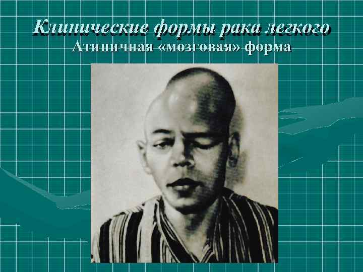 Клинические формы рака легкого Атипичная «мозговая» форма 